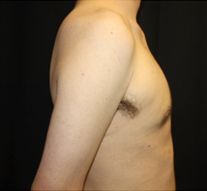 Gynecomastia Before & After Patient #23434