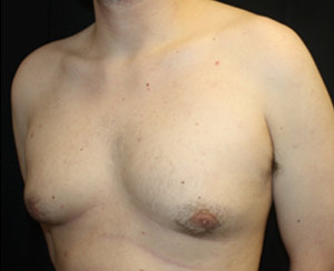 Gynecomastia Before & After Patient #23434