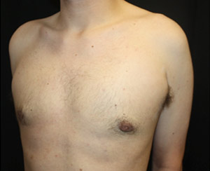 Gynecomastia Before & After Patient #23434