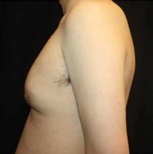 Gynecomastia Before & After Patient #23434