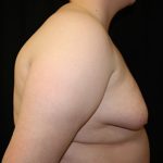 Gynecomastia Before & After Patient #23452