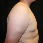 Gynecomastia Before & After Patient #23452