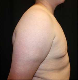 Gynecomastia Before & After Patient #23452