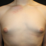 Gynecomastia Before & After Patient #23460