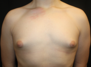 Gynecomastia Before & After Patient #23460