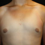 Gynecomastia Before & After Patient #23460