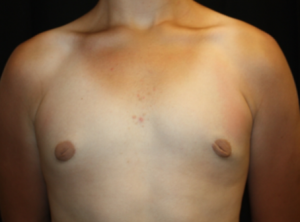 Gynecomastia Before & After Patient #23460