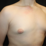 Gynecomastia Before & After Patient #23460