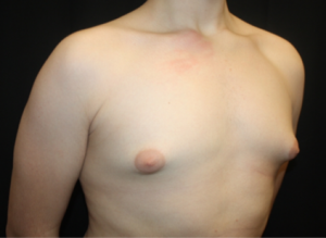 Gynecomastia Before & After Patient #23460