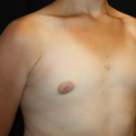 Gynecomastia Before & After Patient #23460