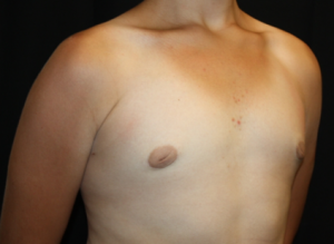 Gynecomastia Before & After Patient #23460