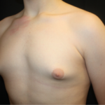 Gynecomastia Before & After Patient #23460