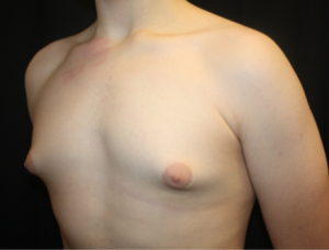 Gynecomastia Before & After Patient #23460