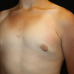 Gynecomastia Before & After Patient #23460