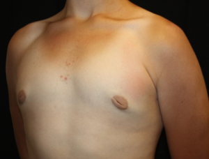 Gynecomastia Before & After Patient #23460