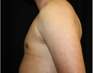 Gynecomastia Before & After Patient #23310