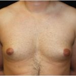 Gynecomastia Before & After Patient #23310