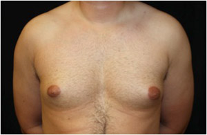 Gynecomastia Before & After Patient #23310