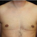 Gynecomastia Before & After Patient #23310