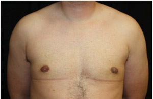 Gynecomastia Before & After Patient #23310