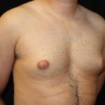 Gynecomastia Before & After Patient #23310