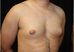 Gynecomastia Before & After Patient #23310