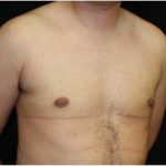 Gynecomastia Before & After Patient #23310