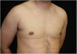 Gynecomastia Before & After Patient #23310