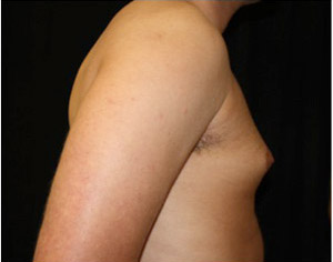 Gynecomastia Before & After Patient #23310