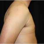 Gynecomastia Before & After Patient #23310