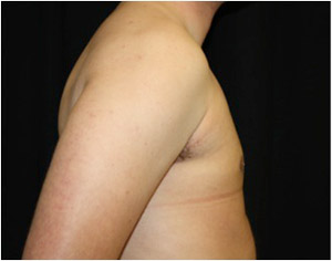 Gynecomastia Before & After Patient #23310