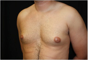 Gynecomastia Before & After Patient #23310