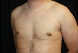 Gynecomastia Before & After Patient #23310