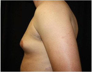 Gynecomastia Before & After Patient #23310