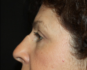 Brow Lift Before & After Patient #21086