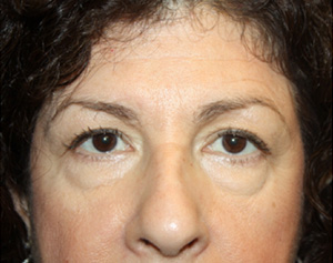 Brow Lift Before & After Patient #21086