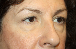 Brow Lift Before & After Patient #21086