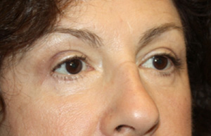 Brow Lift Before & After Patient #21086