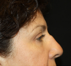 Brow Lift Before & After Patient #21086