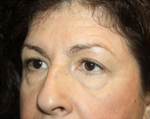 Brow Lift Before & After Patient #21086