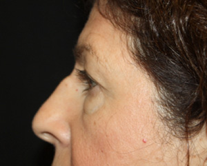 Brow Lift Before & After Patient #21086