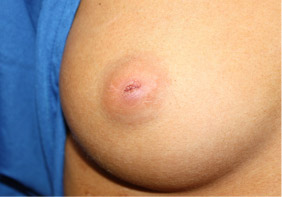 Nipple Revision Before & After Patient #20861