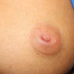 Nipple Revision Before & After Patient #20861