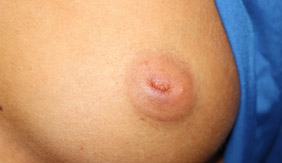 Nipple Revision Before & After Patient #20861