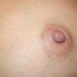 Nipple Revision Before & After Patient #20861