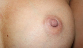 Nipple Revision Before & After Patient #20861