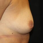 Nipple Revision Before & After Patient #20876