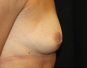 Nipple Revision Before & After Patient #20876