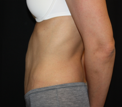 Tummy Tuck Before & After Patient #22917