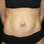 Tummy Tuck Before & After Patient #22917